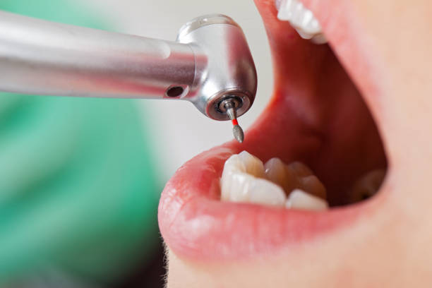 Best Lost Filling or Crown Replacement in Amherst, WI